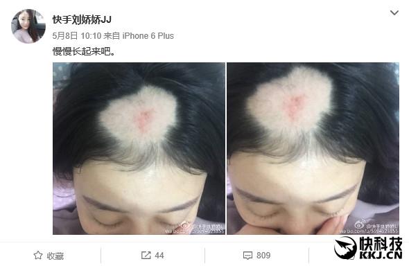 美女電鉆啃玉米變禿頂去看醫(yī)生：真悲劇了