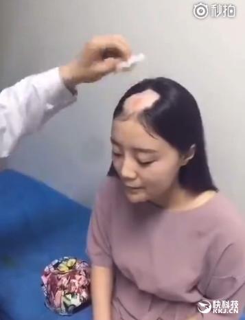 美女電鉆啃玉米變禿頂去看醫(yī)生：真悲劇了